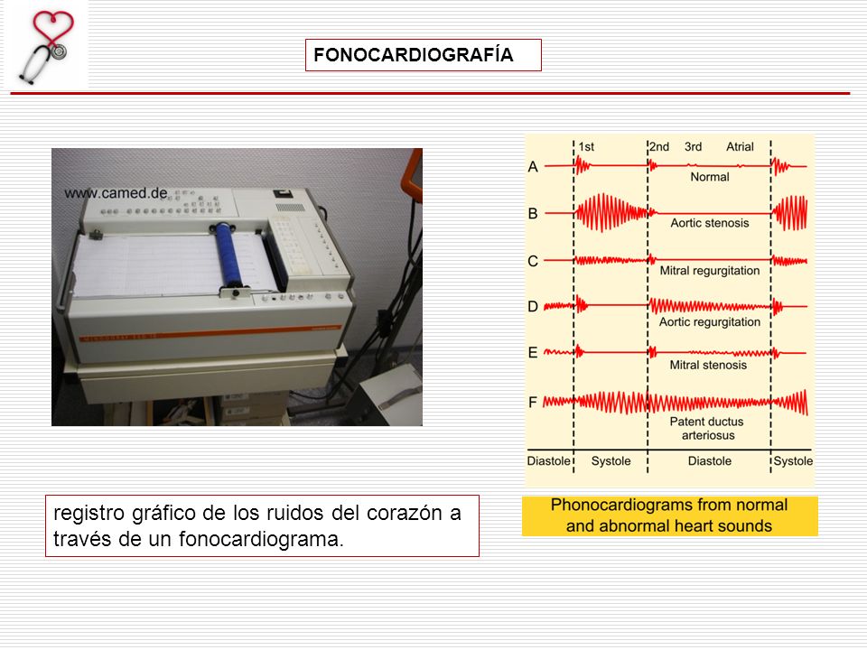 FONOCARDIOGRAFÍA registro gráfico de los ruidos del corazón a través de un fonocardiograma.