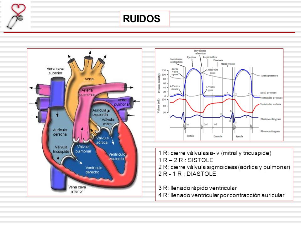 RUIDOS 1 R: cierre válvulas a- v (mitral y tricuspide)