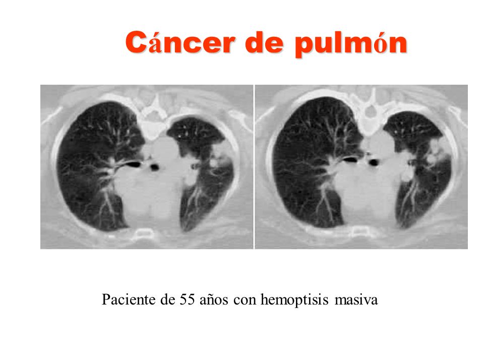Cáncer de pulmón Paciente de 55 años con hemoptisis masiva