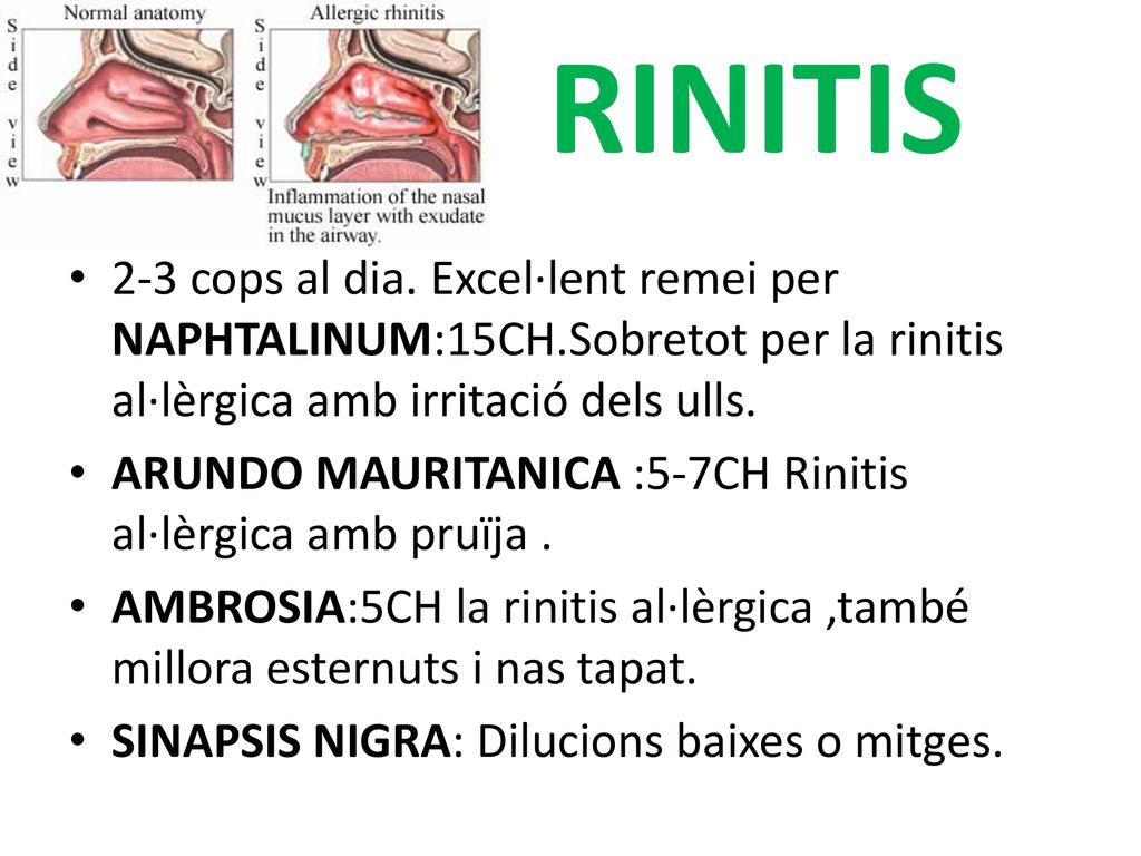 RINITIS 2-3 cops al dia. Excel·lent remei per NAPHTALINUM:15CH.Sobretot per la rinitis al·lèrgica amb irritació dels ulls.