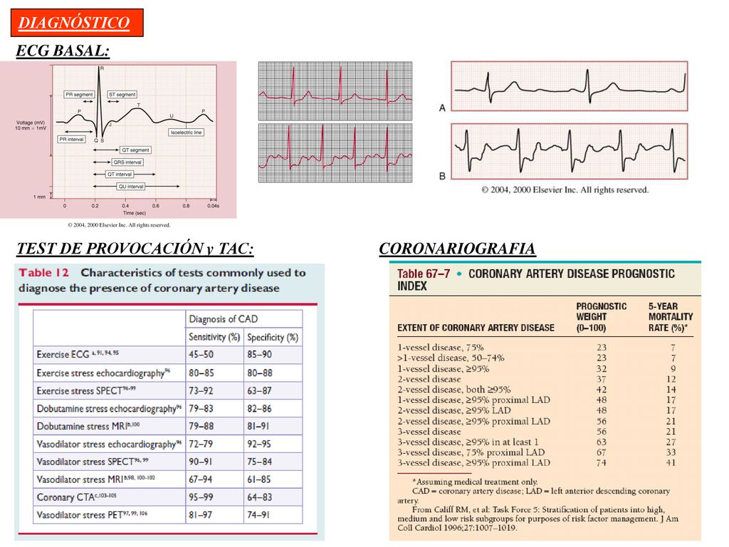 DIAGNÓSTICO ECG BASAL: TEST DE PROVOCACIÓN y TAC: CORONARIOGRAFIA