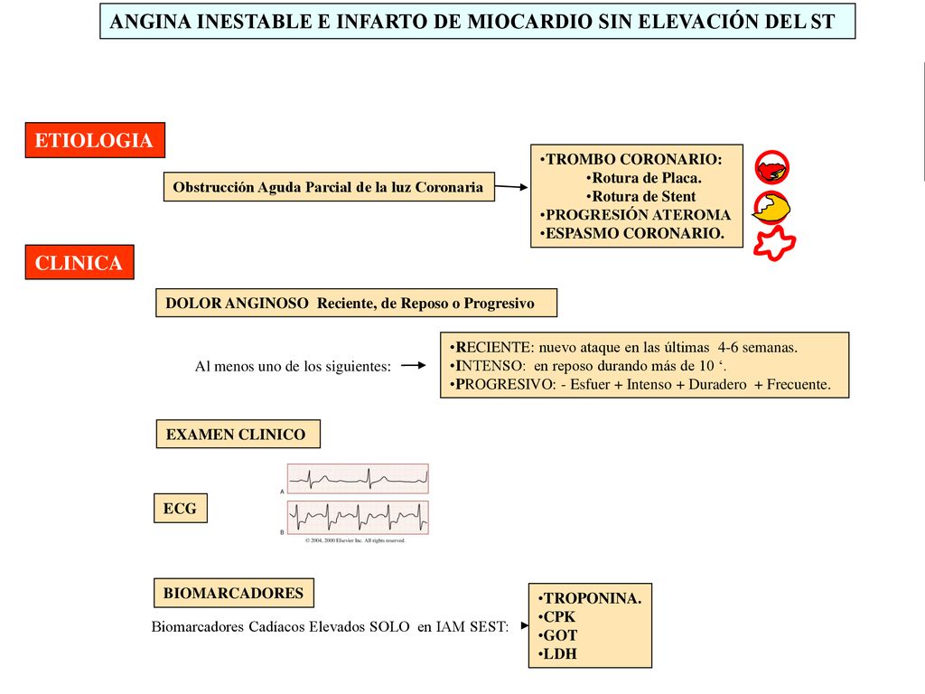 ANGINA INESTABLE E INFARTO DE MIOCARDIO SIN ELEVACIÓN DEL ST