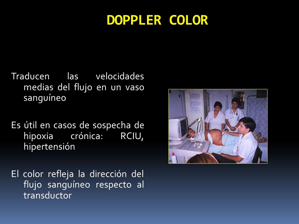 DOPPLER COLOR Traducen las velocidades medias del flujo en un vaso sanguíneo.