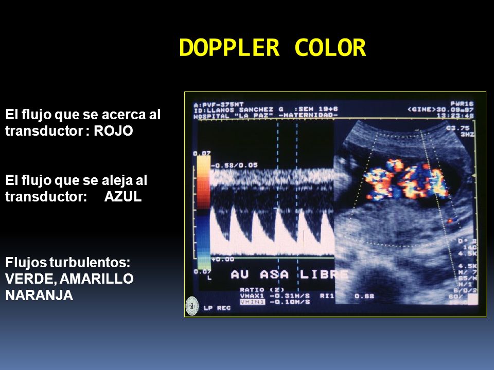 DOPPLER COLOR El flujo que se acerca al transductor : ROJO