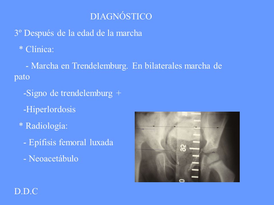 DIAGNÓSTICO 3º Después de la edad de la marcha. * Clínica: - Marcha en Trendelemburg. En bilaterales marcha de pato.