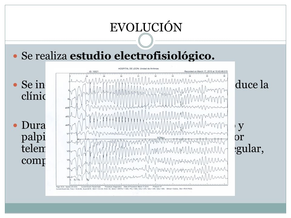 EVOLUCIÓN Se realiza estudio electrofisiológico.