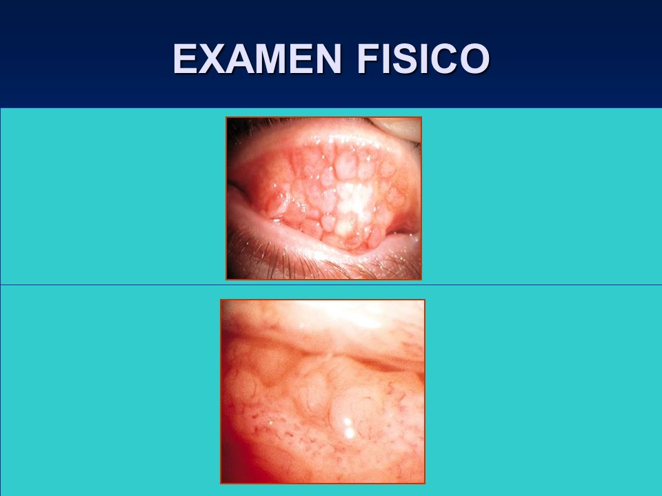 EXAMEN FISICO Folículos : Reacción aguda ( H.V., conj. Inclusión,Q. Epidémica ). Reacción crónica ( tracoma, sind. Axenfeld, Moraxella,etc. )