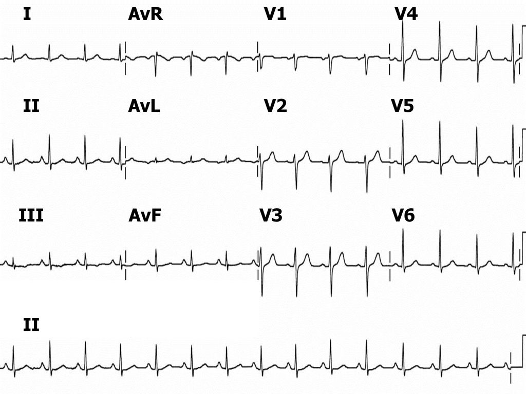 I AvR V1 V4 II AvL V2 V5 III AvF V3 V6 II