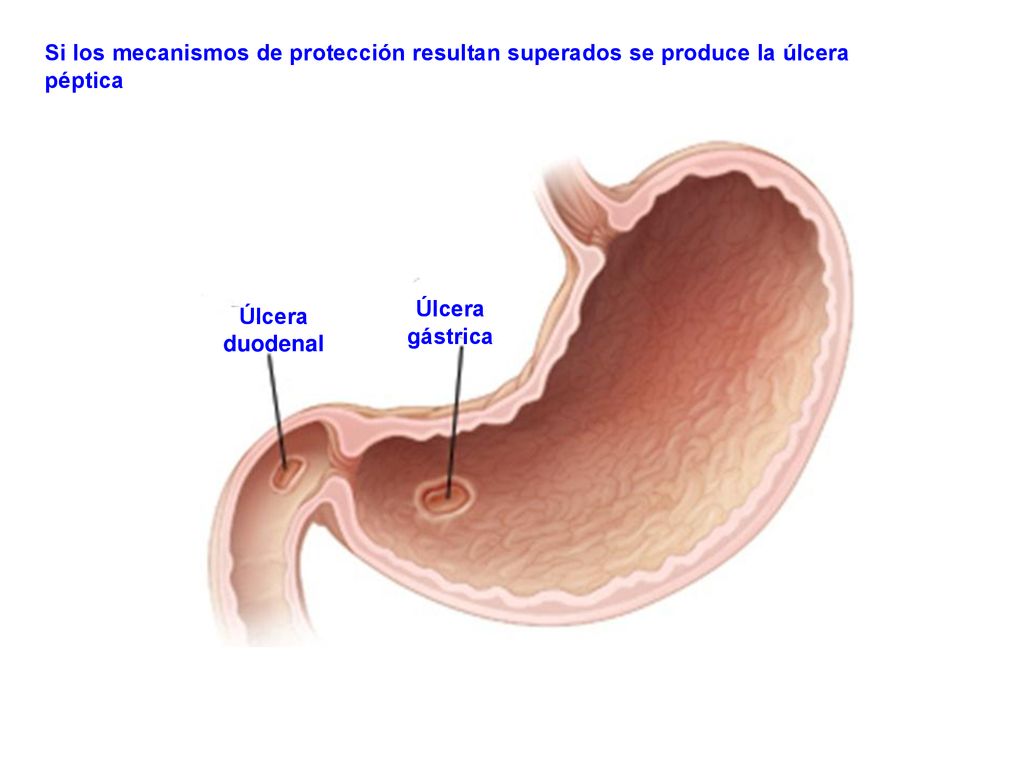 Si los mecanismos de protección resultan superados se produce la úlcera péptica
