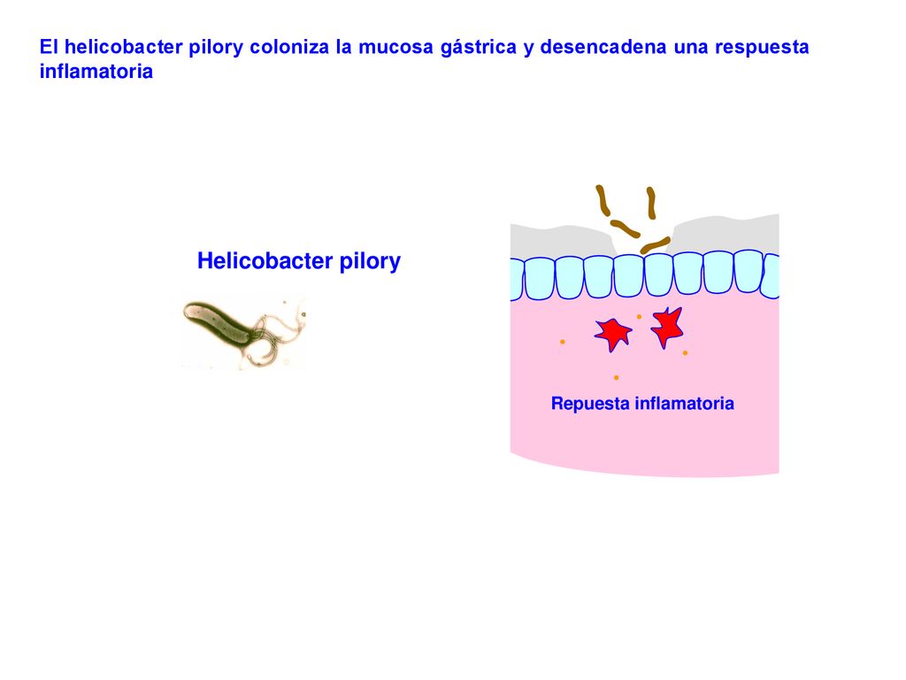 El helicobacter pilory coloniza la mucosa gástrica y desencadena una respuesta inflamatoria