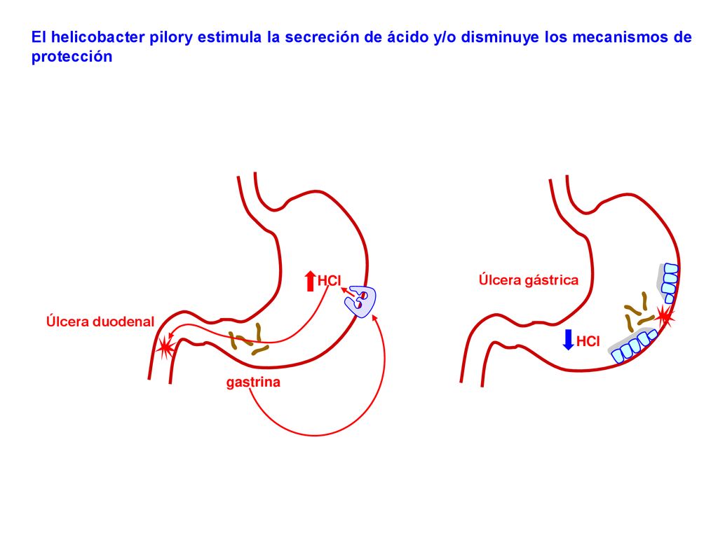 El helicobacter pilory estimula la secreción de ácido y/o disminuye los mecanismos de protección