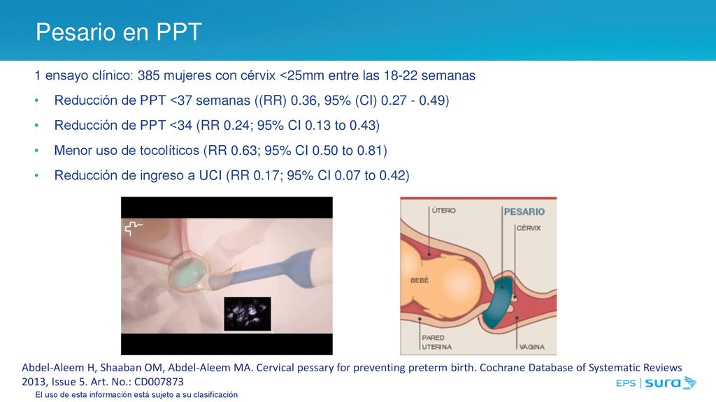 Pesario en PPT 1 ensayo clínico: 385 mujeres con cérvix <25mm entre las semanas.