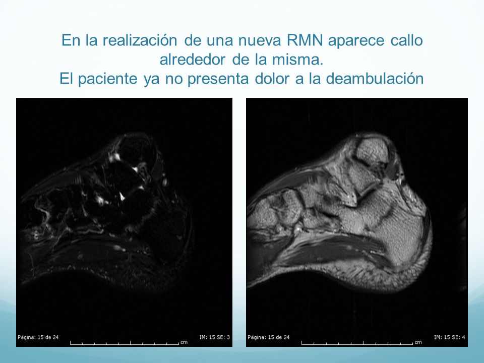 En la realización de una nueva RMN aparece callo alrededor de la misma