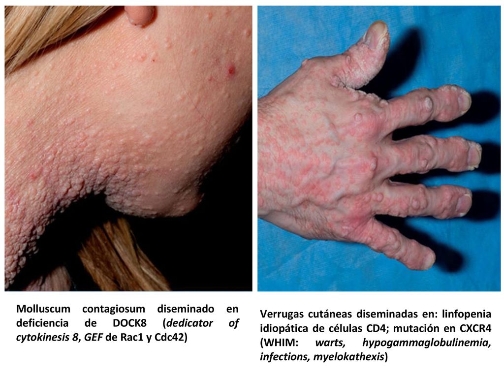 Molluscum contagiosum diseminado en deficiencia de DOCK8 (dedicator of cytokinesis 8, GEF de Rac1 y Cdc42)
