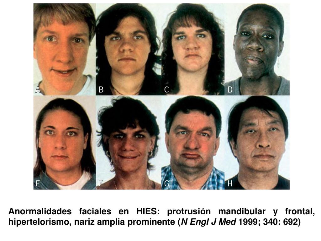 Anormalidades faciales en HIES: protrusión mandibular y frontal, hipertelorismo, nariz amplia prominente (N Engl J Med 1999; 340: 692)