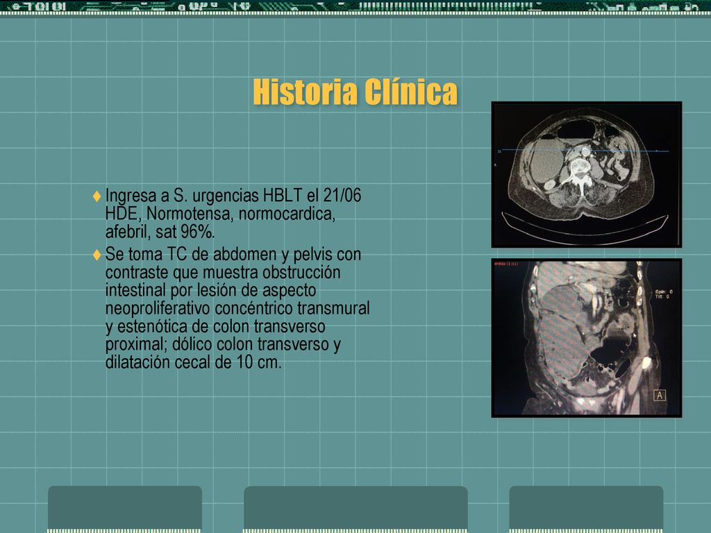 Historia Clínica Ingresa a S. urgencias HBLT el 21/06 HDE, Normotensa, normocardica, afebril, sat 96%.