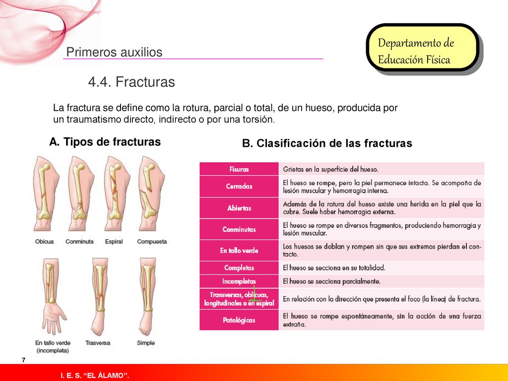 4.4. Fracturas A. Tipos de fracturas B. Clasificación de las fracturas