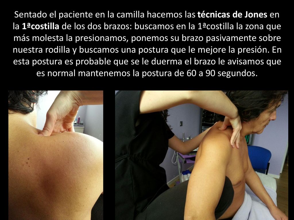 Sentado el paciente en la camilla hacemos las técnicas de Jones en la 1ªcostilla de los dos brazos: buscamos en la 1ªcostilla la zona que más molesta la presionamos, ponemos su brazo pasivamente sobre nuestra rodilla y buscamos una postura que le mejore la presión.