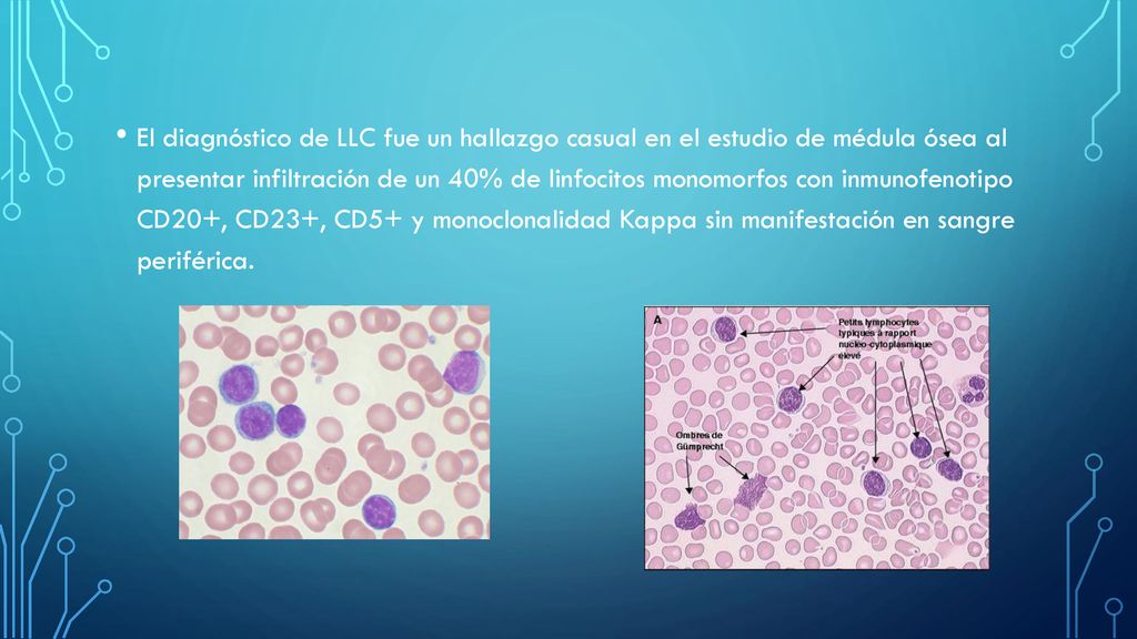 El diagnóstico de LLC fue un hallazgo casual en el estudio de médula ósea al presentar infiltración de un 40% de linfocitos monomorfos con inmunofenotipo CD20+, CD23+, CD5+ y monoclonalidad Kappa sin manifestación en sangre periférica.