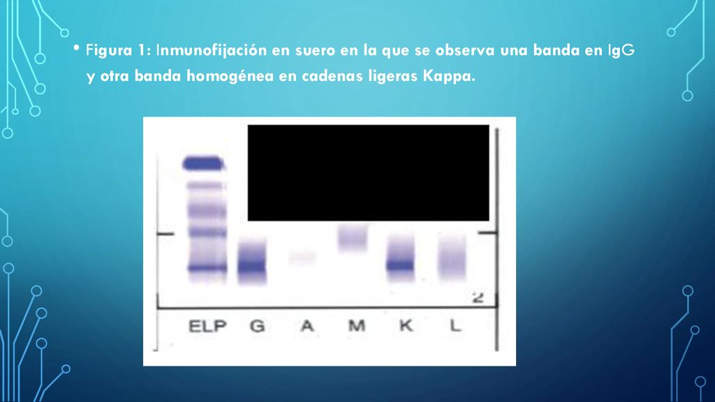 Figura 1: Inmunofijación en suero en la que se observa una banda en IgG y otra banda homogénea en cadenas ligeras Kappa.
