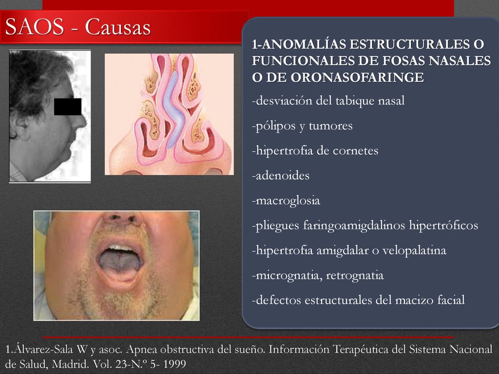 SAOS - Causas 1-ANOMALÍAS ESTRUCTURALES O FUNCIONALES DE FOSAS NASALES O DE ORONASOFARINGE. -desviación del tabique nasal.