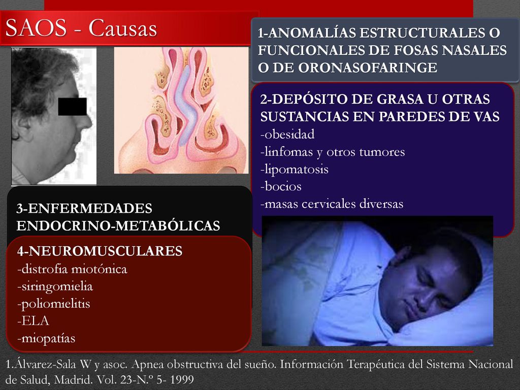 SAOS - Causas 1-ANOMALÍAS ESTRUCTURALES O FUNCIONALES DE FOSAS NASALES O DE ORONASOFARINGE. 2-DEPÓSITO DE GRASA U OTRAS SUSTANCIAS EN PAREDES DE VAS.