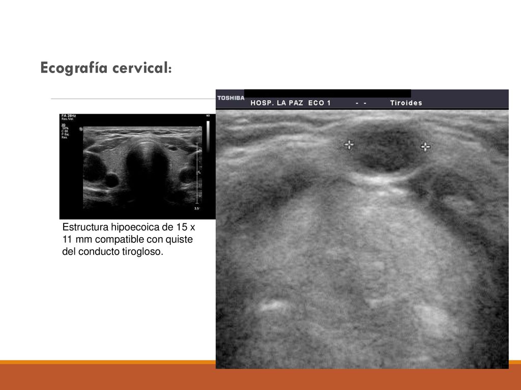 Ecografía cervical: Estructura hipoecoica de 15 x 11 mm compatible con quiste del conducto tirogloso.