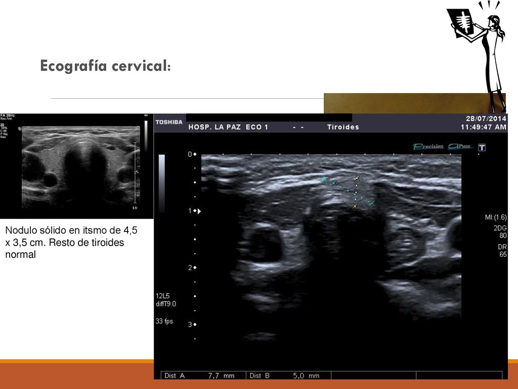 Ecografía cervical: Nodulo sólido en itsmo de 4,5 x 3,5 cm. Resto de tiroides normal