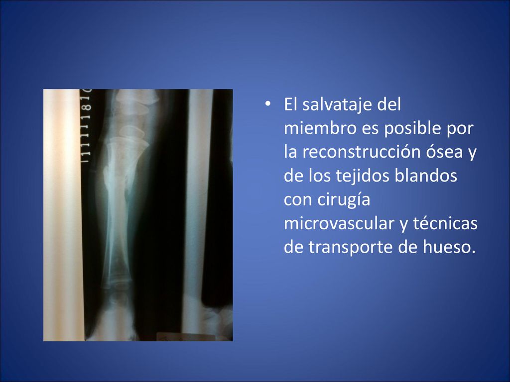 El salvataje del miembro es posible por la reconstrucción ósea y de los tejidos blandos con cirugía microvascular y técnicas de transporte de hueso.