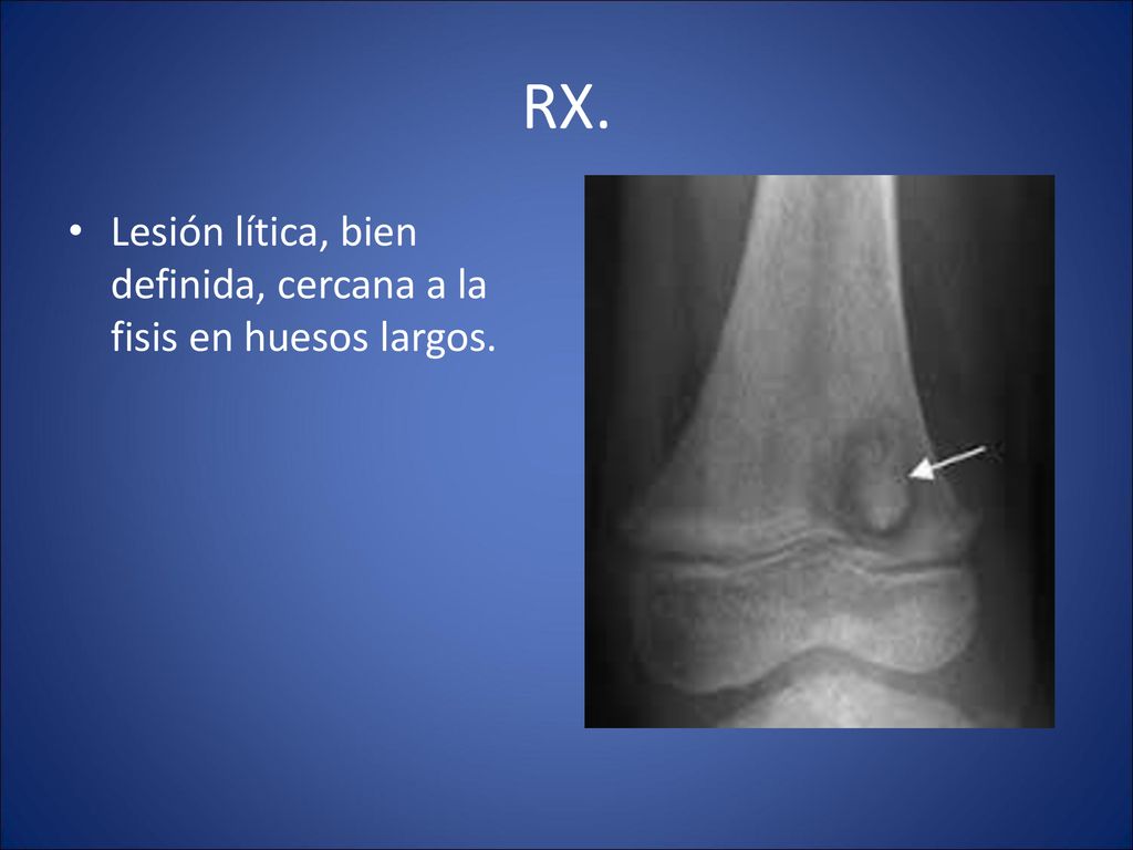 RX. Lesión lítica, bien definida, cercana a la fisis en huesos largos.