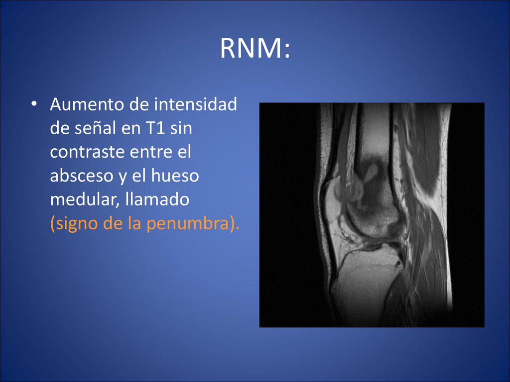 RNM: Aumento de intensidad de señal en T1 sin contraste entre el absceso y el hueso medular, llamado (signo de la penumbra).