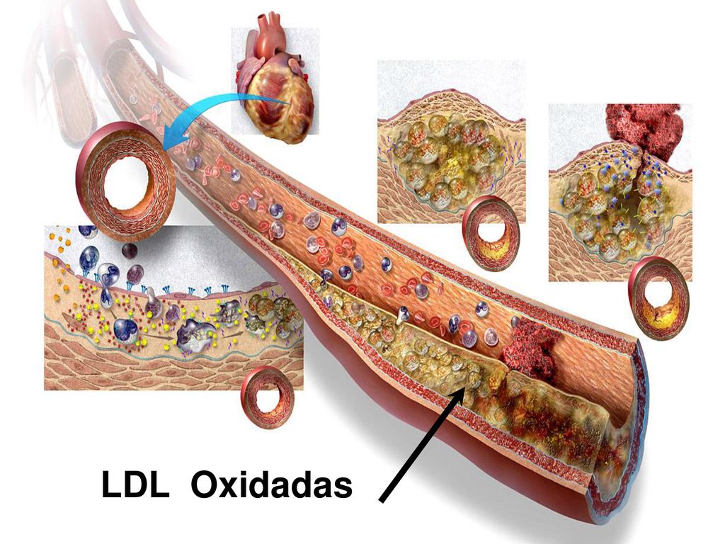 Estas LDL oxidadas se deposita en la pared arterial, lo que conlleva a la formación de la placa arterioesclerótica