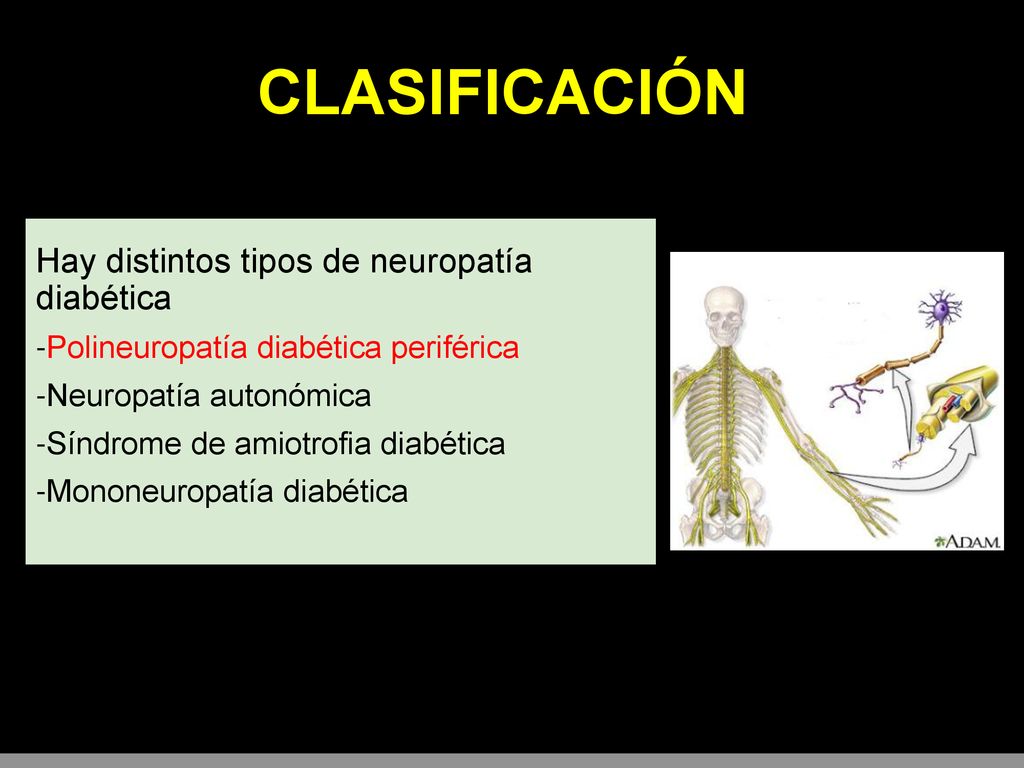 CLASIFICACIÓN Hay distintos tipos de neuropatía diabética