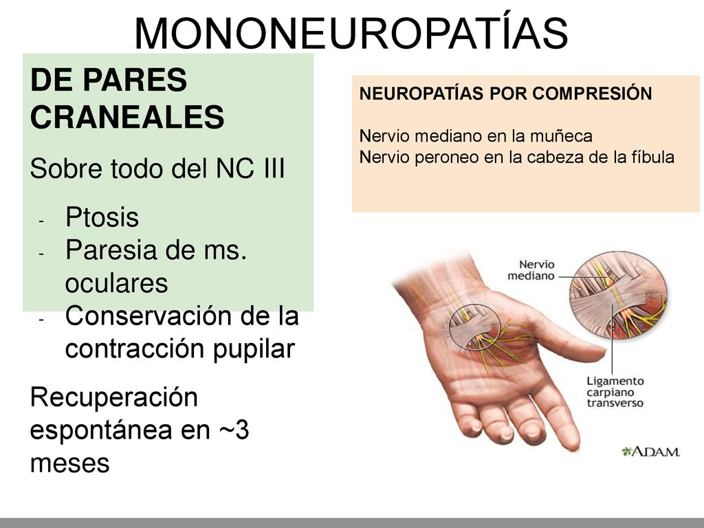 MONONEUROPATÍAS DE PARES CRANEALES Sobre todo del NC III Ptosis