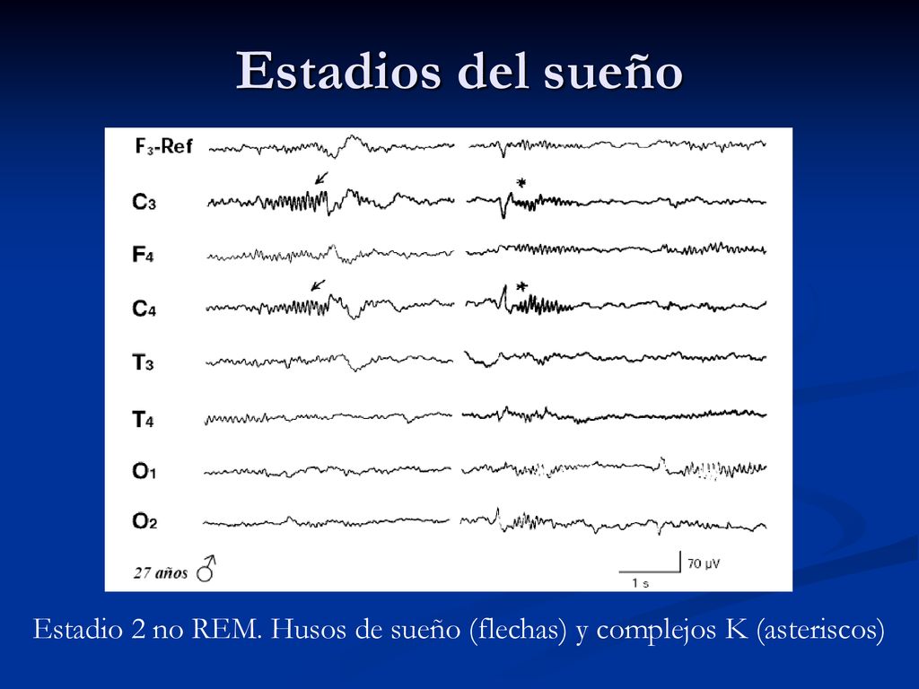 Estadio 2 no REM. Husos de sueño (flechas) y complejos K (asteriscos)