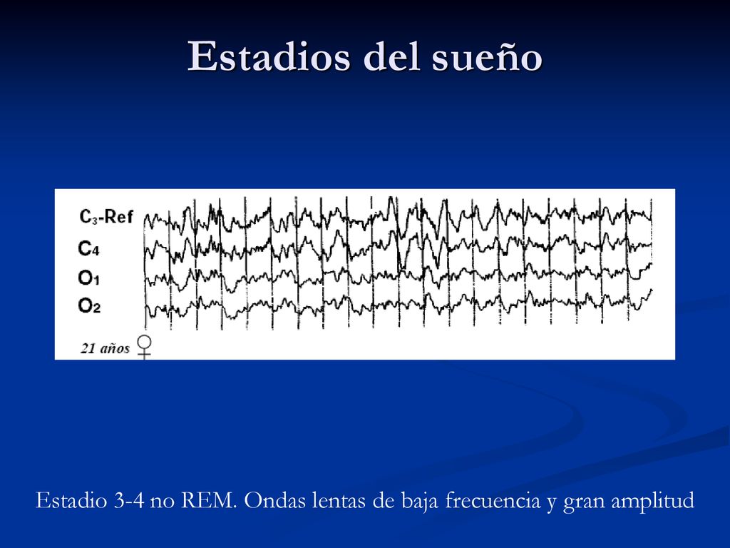 Estadio 3-4 no REM. Ondas lentas de baja frecuencia y gran amplitud