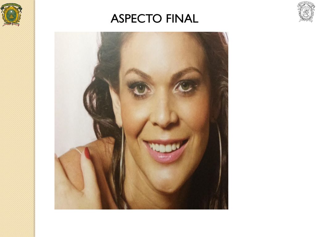 ASPECTO FINAL Finalmente después de recomendar al material mas apto para nuestro paciente este es el resultado final y con gran confianza sonrien.