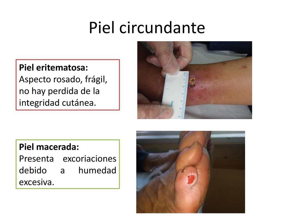 Piel circundante Piel eritematosa: Aspecto rosado, frágil, no hay perdida de la integridad cutánea.