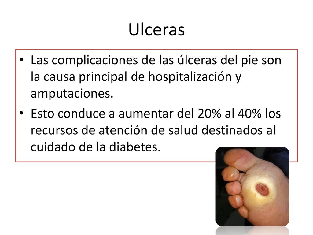 Ulceras Las complicaciones de las úlceras del pie son la causa principal de hospitalización y amputaciones.