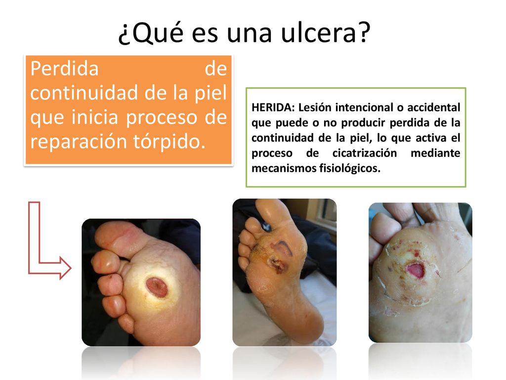¿Qué es una ulcera Perdida de continuidad de la piel que inicia proceso de reparación tórpido.