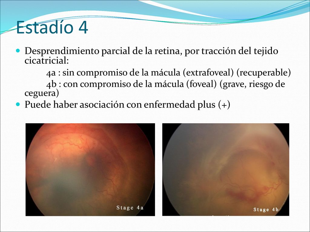 Estadío 4 Desprendimiento parcial de la retina, por tracción del tejido cicatricial: 4a : sin compromiso de la mácula (extrafoveal) (recuperable)