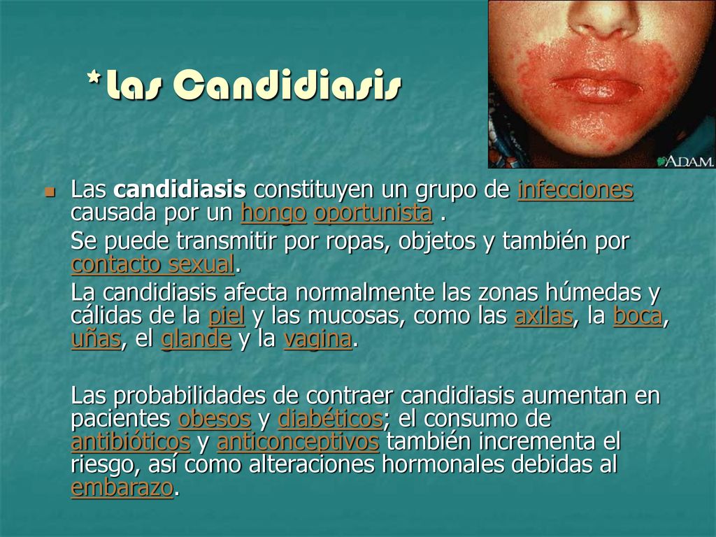 *Las Candidiasis Las candidiasis constituyen un grupo de infecciones causada por un hongo oportunista .