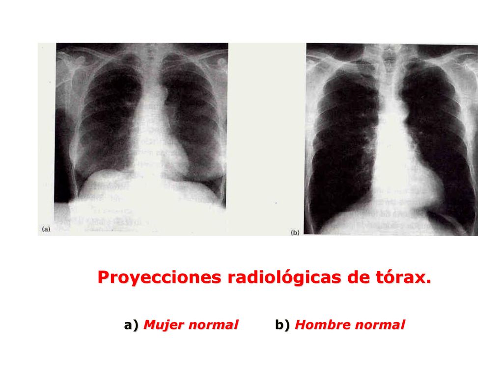 Proyecciones radiológicas de tórax. a) Mujer normal b) Hombre normal