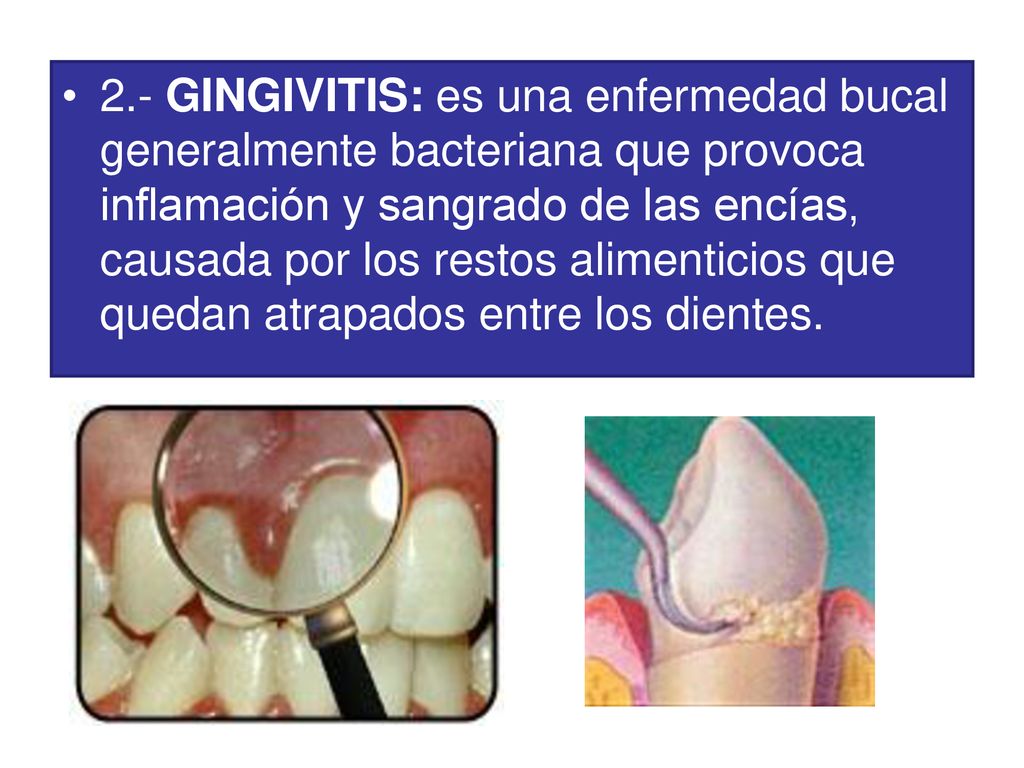 2.- GINGIVITIS: es una enfermedad bucal generalmente bacteriana que provoca inflamación y sangrado de las encías, causada por los restos alimenticios que quedan atrapados entre los dientes.