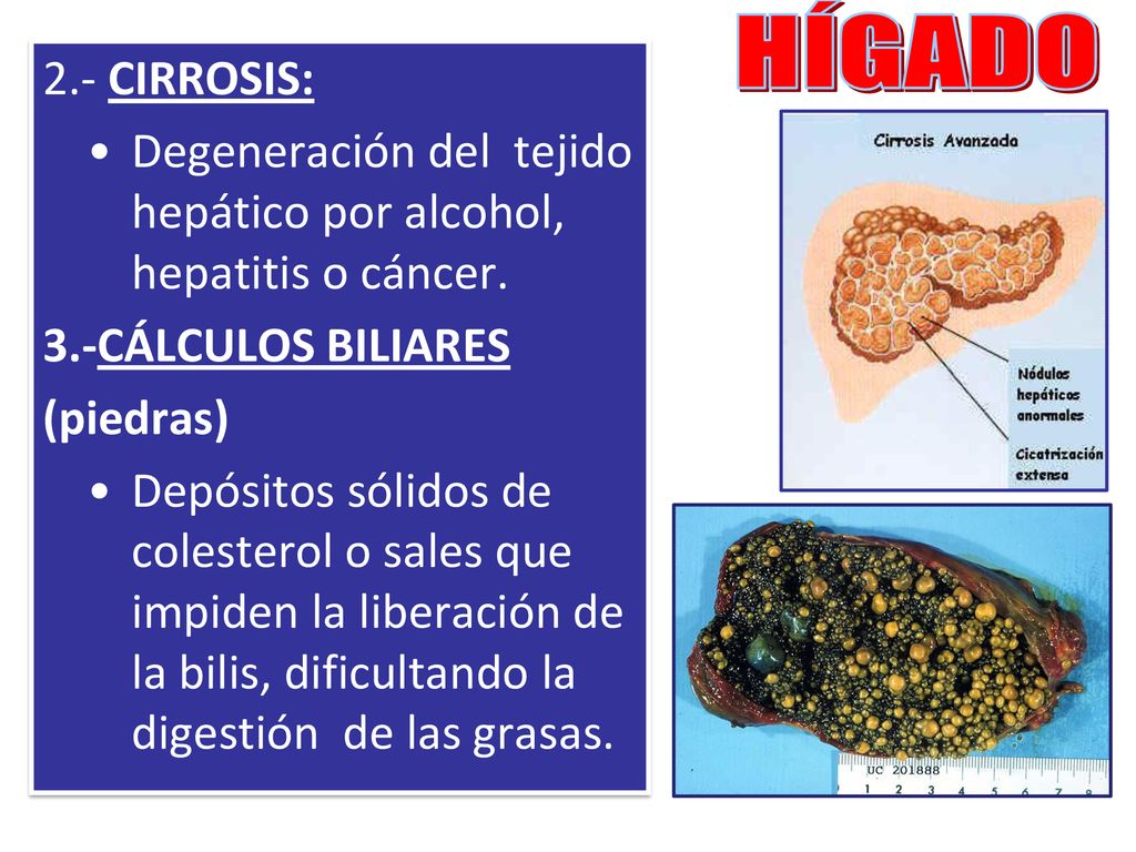 HÍGADO 2.- CIRROSIS: Degeneración del tejido hepático por alcohol, hepatitis o cáncer. 3.-CÁLCULOS BILIARES.