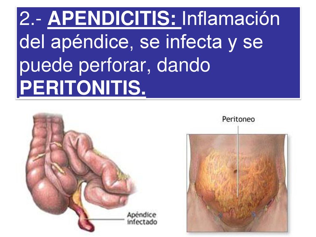 2.- APENDICITIS: Inflamación del apéndice, se infecta y se puede perforar, dando PERITONITIS.