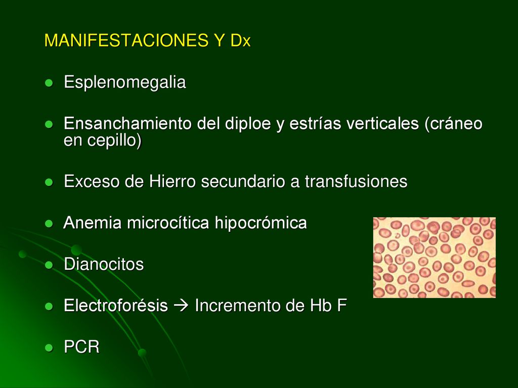 MANIFESTACIONES Y Dx Esplenomegalia. Ensanchamiento del diploe y estrías verticales (cráneo en cepillo)