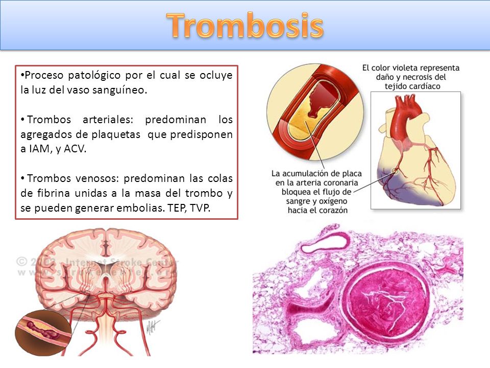 Trombosis Proceso patológico por el cual se ocluye la luz del vaso sanguíneo.