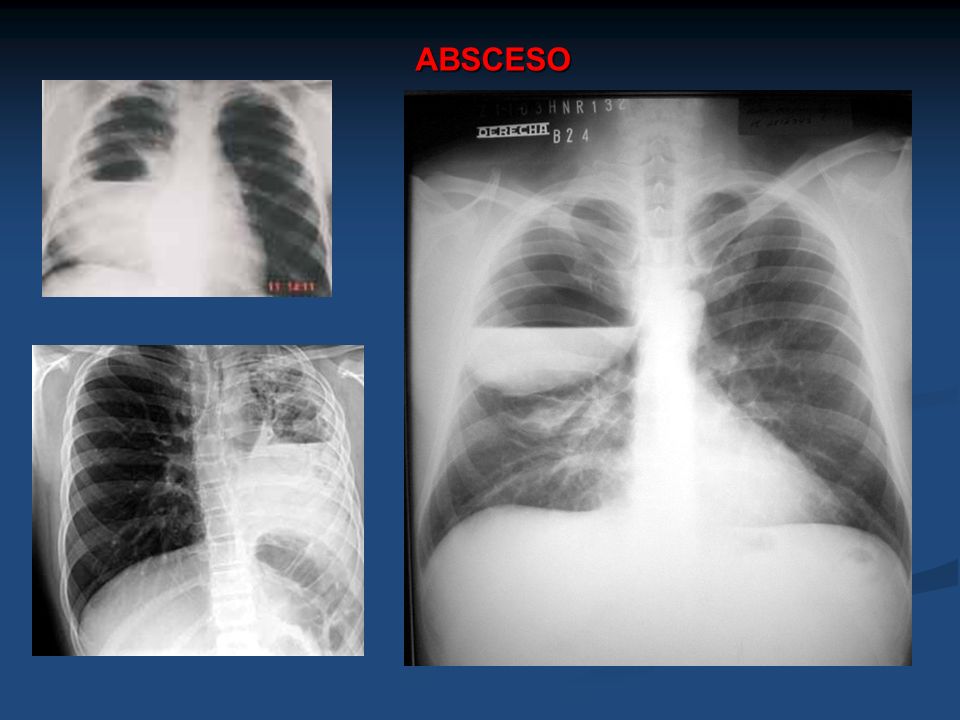 ABSCESO
