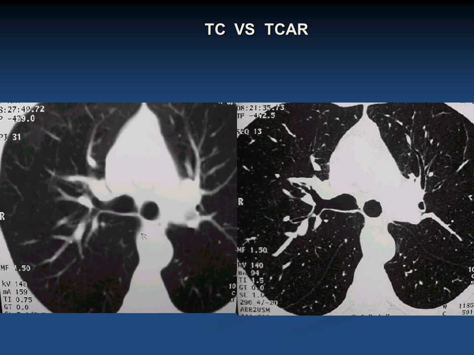 TC VS TCAR